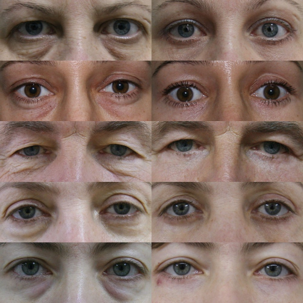 Vorher-nachher-Vergleich einer Frau, die eine Reduzierung von Falten und erschlaffter Haut nach der Behandlung zeigt, wobei das Nachher-Bild ein jüngeres und erfrischtes Erscheinungsbild zeigt.